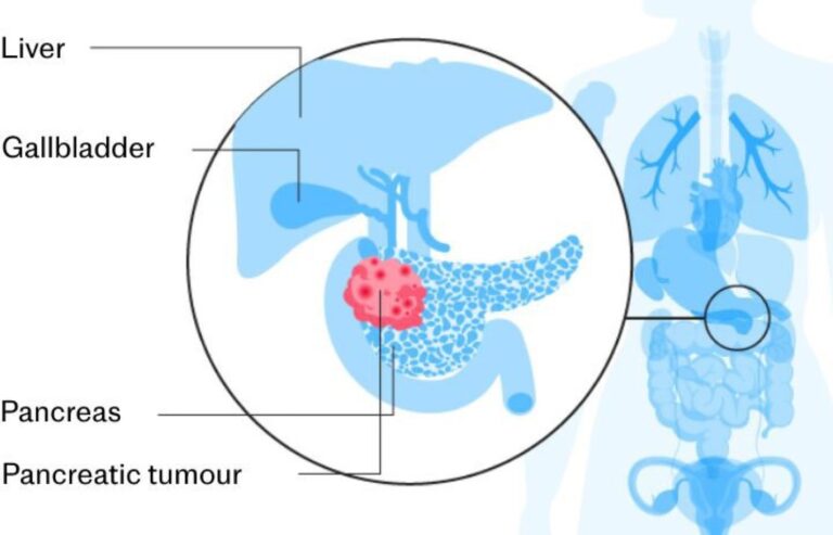 Jak chronić trzustkę podczas stosowania leków odchudzających takich jak Mounjaro i Wegovy trzustka schemat